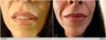 Correction de la lèvre avec de la toxine botulique