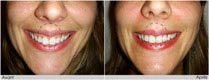 Correction du sourire gingival avec de la toxine botulique